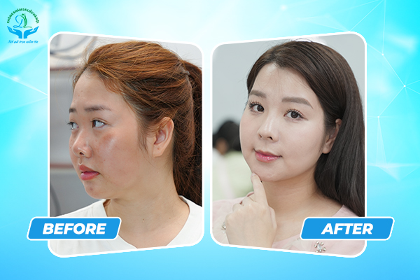 Nên trẻ hóa da bằng phương pháp nào để kịp Tết?